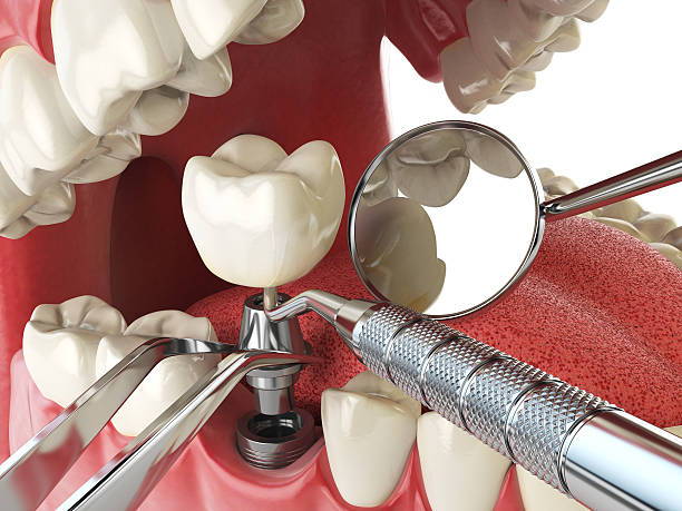 Best Broken or Chipped Tooth Repair in Eastman, GA